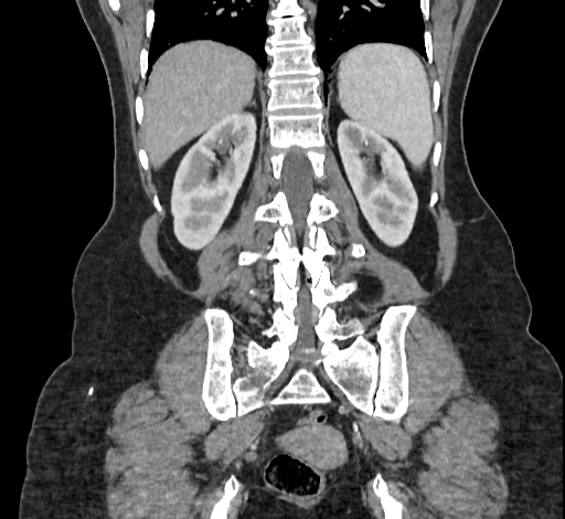File:Ampullary tumor (Radiopaedia 60333-67998 B 59).jpg