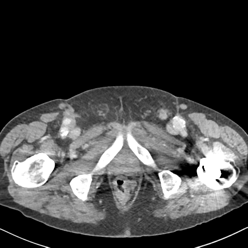 File:Amyand hernia (Radiopaedia 39300-41547 A 77).png