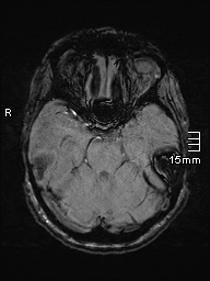 Amyotrophic lateral sclerosis (Radiopaedia 70821-81017 Axial SWI 14).jpg