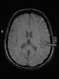 Amyotrophic lateral sclerosis (Radiopaedia 70821-81017 Axial SWI 31).jpg