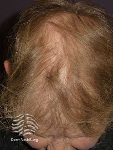 File:Anagen effluvium due to cranial irradiation (DermNet NZ hair-nails-sweat-anagen-effluvium-18).jpg