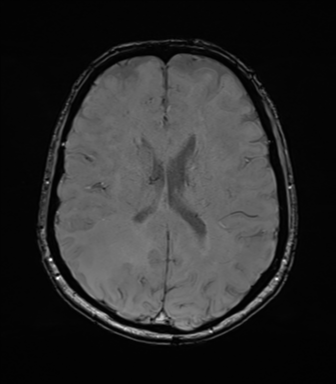 Anaplastic astrocytoma (Radiopaedia 86943-103160 Axial SWI 55).png