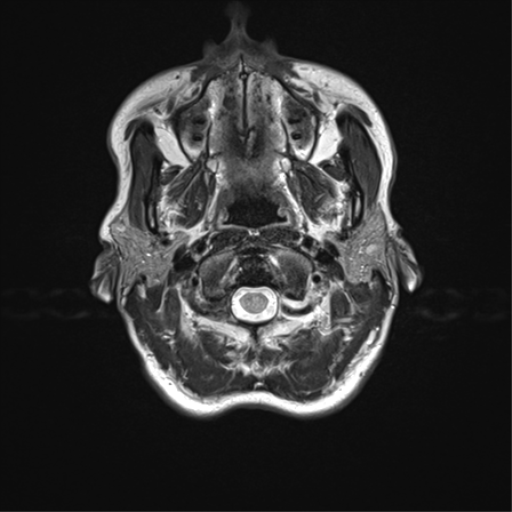 File:Anaplastic astrocytoma IDH mutant (Radiopaedia 50046-55341 Axial T2 2).png