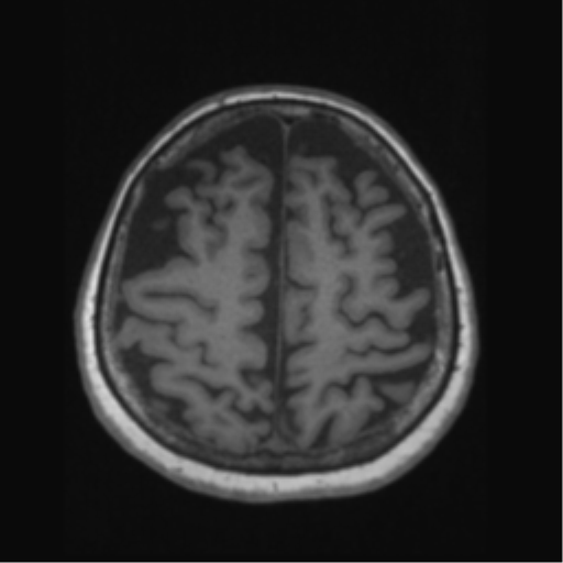 Anaplastic astrocytoma IDH wild-type (pseudoprogression) (Radiopaedia 42209-45276 Axial T1 114).png