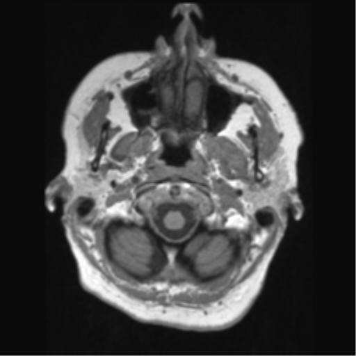 Anaplastic astrocytoma IDH wild-type (pseudoprogression) (Radiopaedia 42209-45276 Axial T1 18).png