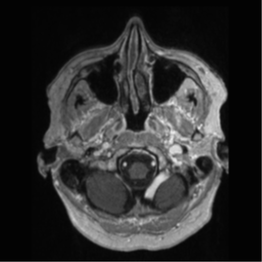File:Anaplastic astrocytoma IDH wild-type (pseudoprogression) (Radiopaedia 42209-45277 Axial T1 C+ 8).png