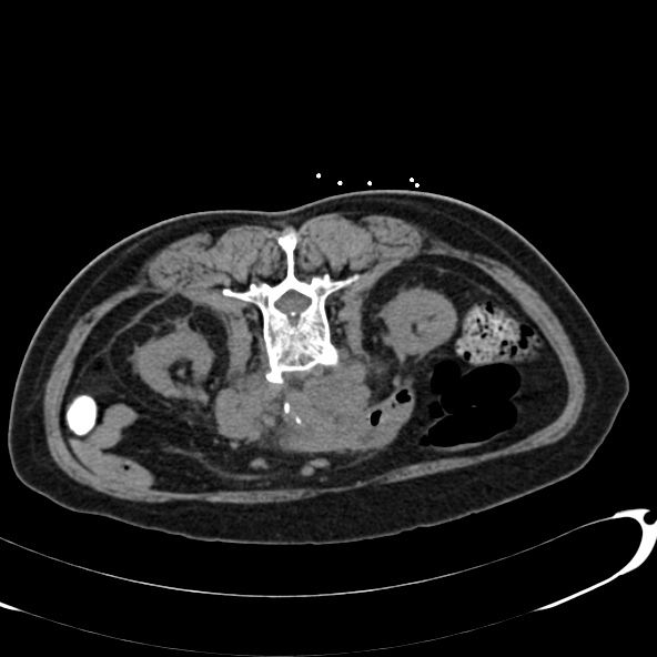 File:Anaplastic lymphoma - with CT biopsy (Radiopaedia 21643-21602 Axial non-contrast 35).jpg