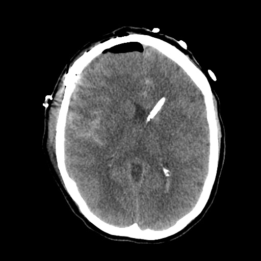 Aneursym related subarachnoid hemorrhage with hydrocephalus (Radiopaedia 45105-49085 Axial non-contrast 27).jpg