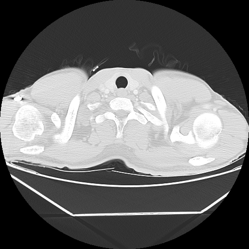 File:Aneurysmal bone cyst - rib (Radiopaedia 82167-96220 Axial lung window 8).jpg