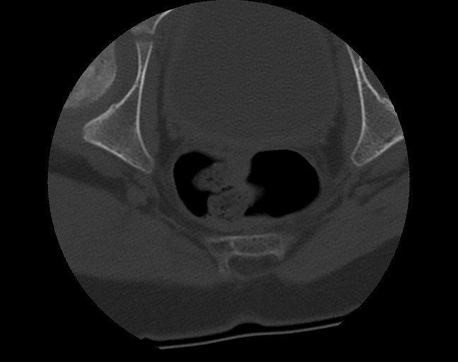 Aneurysmal bone cyst - sacrum (Radiopaedia 65190-74195 Axial bone window 45).jpg