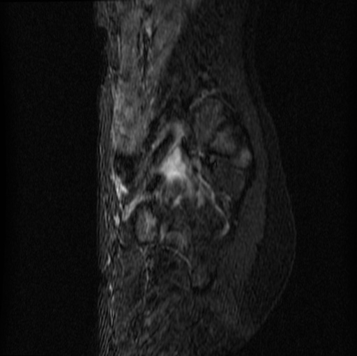 File:Aneurysmal bone cyst - sacrum (Radiopaedia 65190-74196 Sagittal STIR 23).jpg