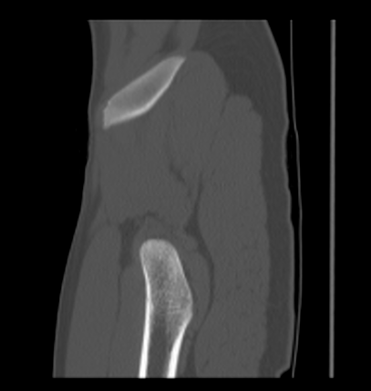 Aneurysmal bone cyst of ischium (Radiopaedia 25957-26094 Sagittal bone window 11).png