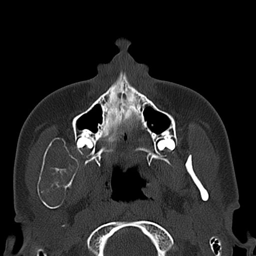 Aneurysmal bone cyst of the mandible (Radiopaedia 43280-46601 Axial bone window 56).jpg