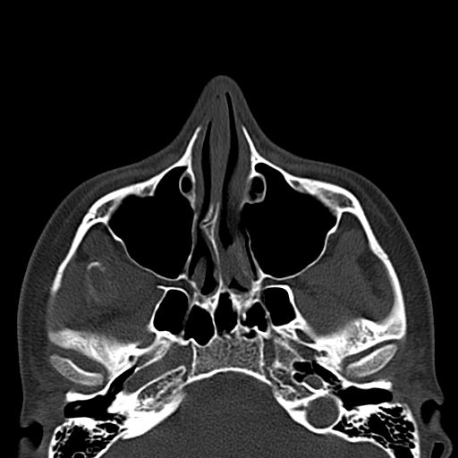 File:Aneurysmal bone cyst of the mandible (Radiopaedia 43280-46601 Axial bone window 77).jpg