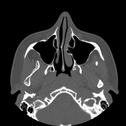 Aneurysmal bone cyst of the mandible (Radiopaedia 43280-46823 Axial bone window 127).jpg
