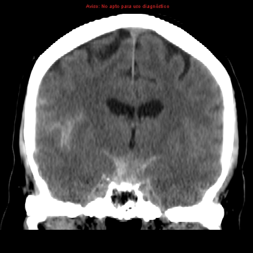 File:Aneurysmal subarachnoid hemorrhage (Radiopaedia 24740-24997 Coronal non-contrast 23).jpg
