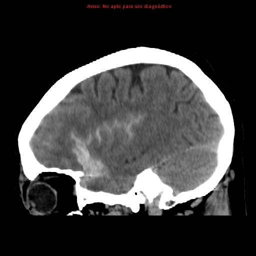 File:Aneurysmal subarachnoid hemorrhage (Radiopaedia 24740-24997 non-contrast 13).jpg