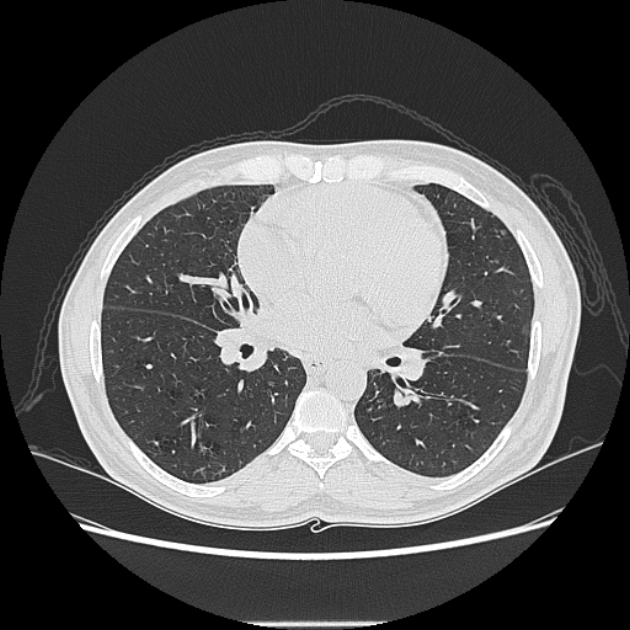 Angioinvasive aspergellosis (Radiopaedia 66995-76315 Axial lung window 28).jpg
