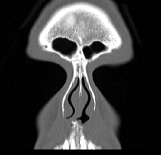 Angular epidermoid cyst (Radiopaedia 46908-51439 Coronal bone window 15).png