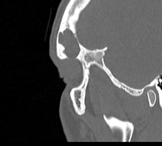 Angular epidermoid cyst (Radiopaedia 46908-51439 Sagittal bone window 87).png