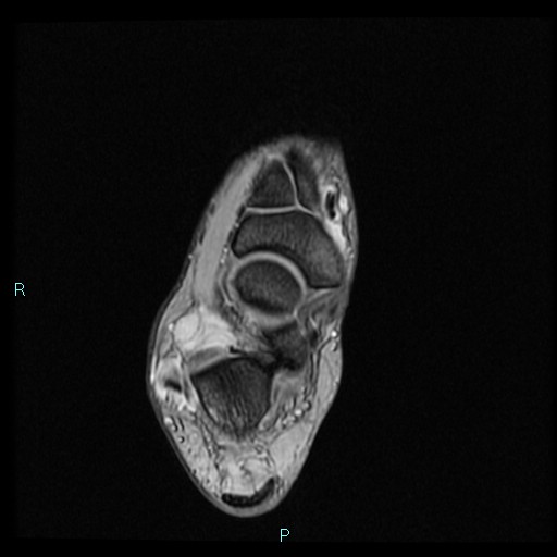 Ankle ganglion cyst (Radiopaedia 62809-71162 Axial Gradient Echo 38).jpg