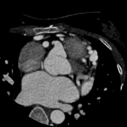 File:Anomalous left coronary artery from the pulmonary artery (ALCAPA) (Radiopaedia 40884-43586 A 26).jpg