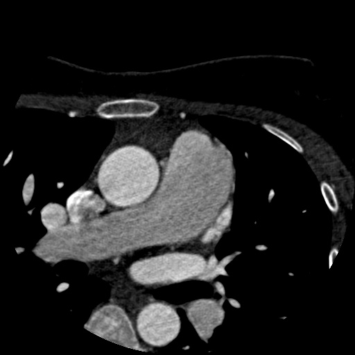 File:Anomalous left coronary artery from the pulmonary artery (ALCAPA) (Radiopaedia 40884-43586 A 3).jpg