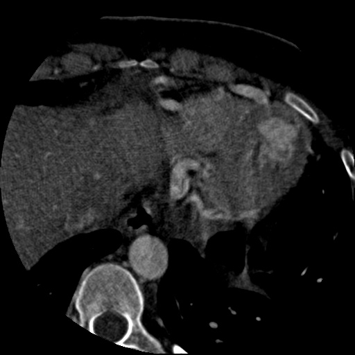 File:Anomalous left coronary artery from the pulmonary artery (ALCAPA) (Radiopaedia 40884-43586 A 77).jpg