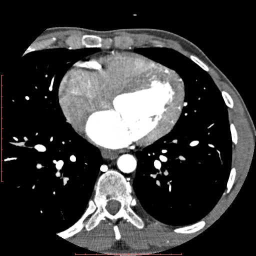 Anomalous left coronary artery from the pulmonary artery (ALCAPA) (Radiopaedia 70148-80181 A 205).jpg