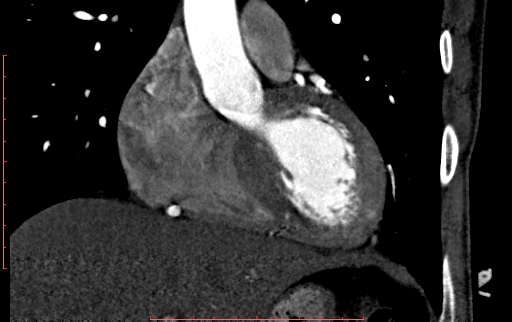 Anomalous left coronary artery from the pulmonary artery (ALCAPA) (Radiopaedia 70148-80181 B 117).jpg