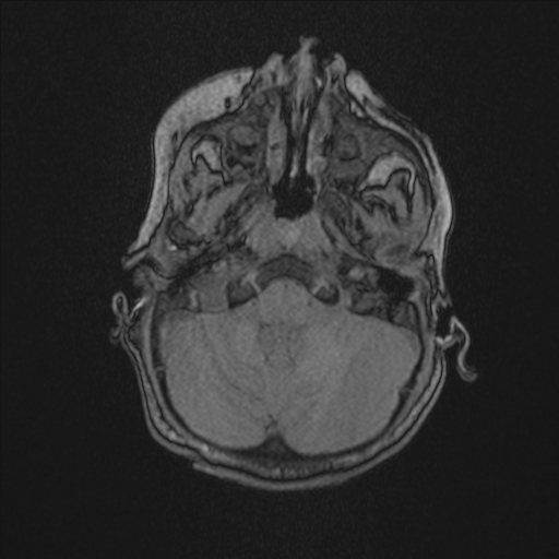 File:Anoxic brain injury (Radiopaedia 79165-92139 Axial MRA 40).jpg