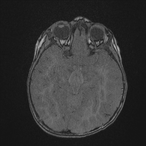 Anoxic brain injury (Radiopaedia 79165-92139 Axial MRA 92).jpg