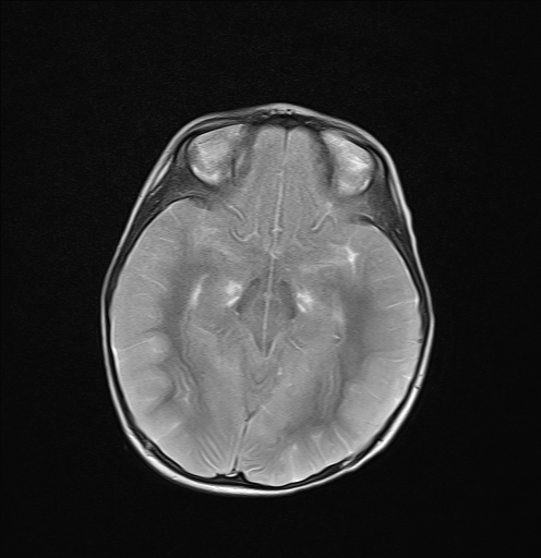 File:Anoxic brain injury (Radiopaedia 79165-92139 Axial T2 12).jpg