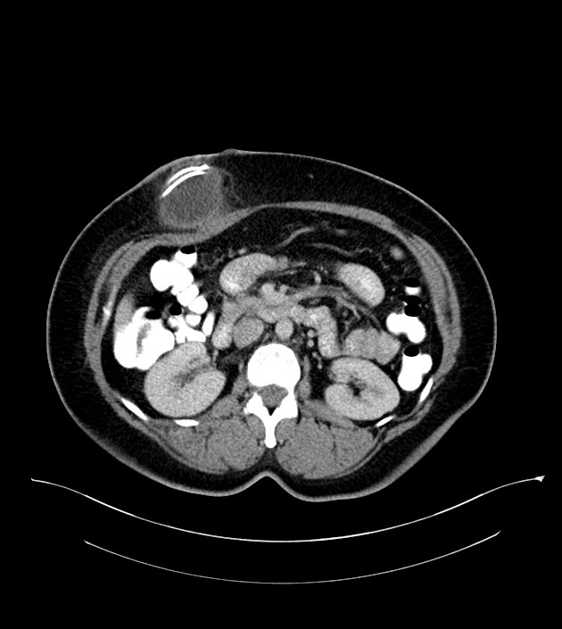 Anterior abdominal wall CSF pseudocyst (CSFoma) (Radiopaedia 79453-92571 A 40).jpg