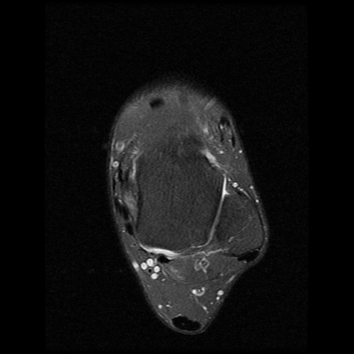 File:Anterior calcaneal process fracture (Radiopaedia 74654-85611 Axial PD fat sat 8).jpg