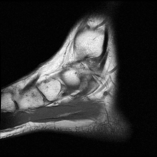 File:Anterior calcaneal process fracture (Radiopaedia 74654-85611 Sagittal T1 4).jpg