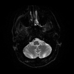 Anterior cerebral artery infarction (Radiopaedia 46794-51323 Axial DWI 33).jpg