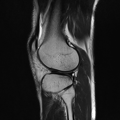 File:Anterior cruciate ligament full thickness tear (Radiopaedia 66268-75467 Sagittal T2 18).jpg