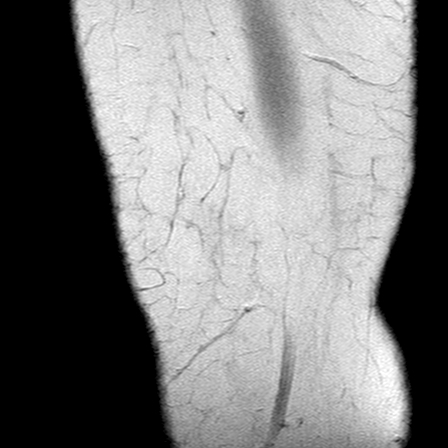 File:Anterior cruciate ligament mucoid degeneration (Radiopaedia 60853-68633 Sagittal PD 3).jpg