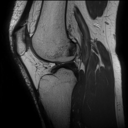 Anterior cruciate ligament rupture and posteromedial corner injury (Radiopaedia 67338-76723 Sagittal PD 99).jpg