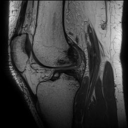 Anterior cruciate ligament rupture with Segond fracture (Radiopaedia 69043-78806 Sagittal PD 105).jpg