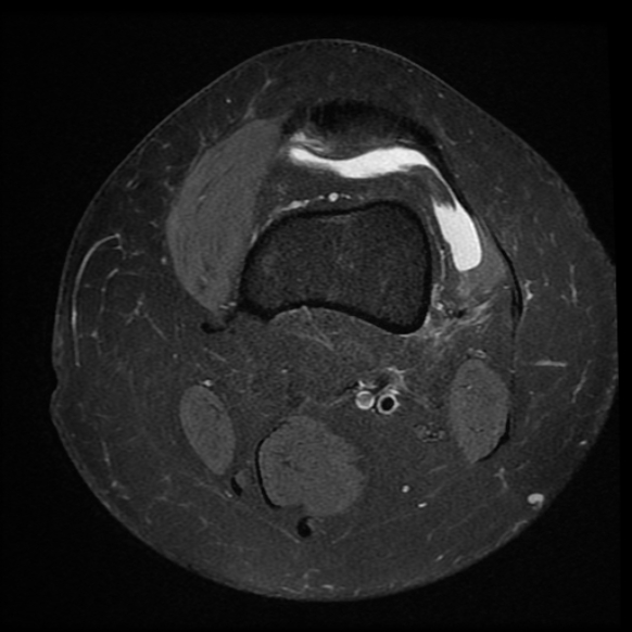 File:Anterior cruciate ligament tear, Wrisberg rip and bucket-handle tear of medial meniscus (Radiopaedia 75872-87266 Axial PD fat sat 25).jpg