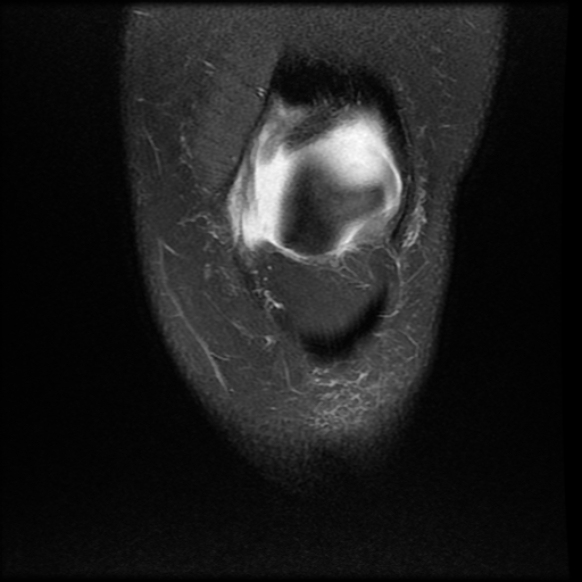 File:Anterior cruciate ligament tear, Wrisberg rip and bucket-handle tear of medial meniscus (Radiopaedia 75872-87266 Coronal PD fat sat 5).jpg
