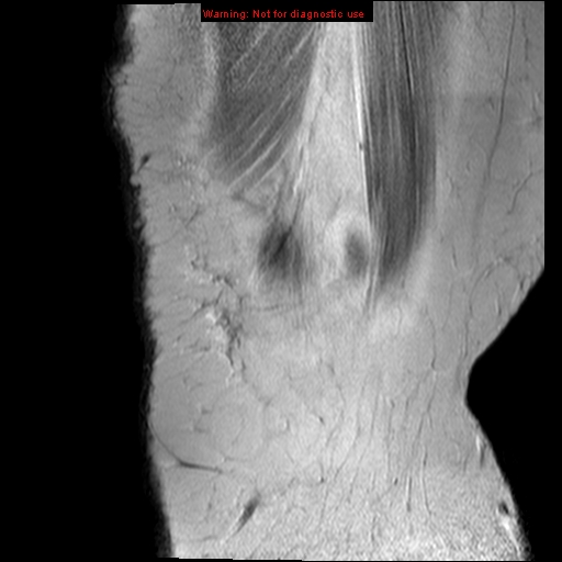 File:Anterior cruciate ligament tear - complete (Radiopaedia 12175-12514 Sagittal PD 21).jpg
