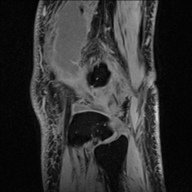Anterior cruciate ligament tear - ramp lesion (Radiopaedia 71883-82322 Sagittal T1 vibe 23).jpg