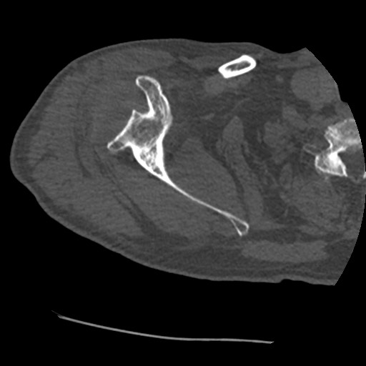 Anterior glenohumeral dislocation with Hill-Sachs lesion (Radiopaedia 62877-71249 Axial bone window 28).jpg