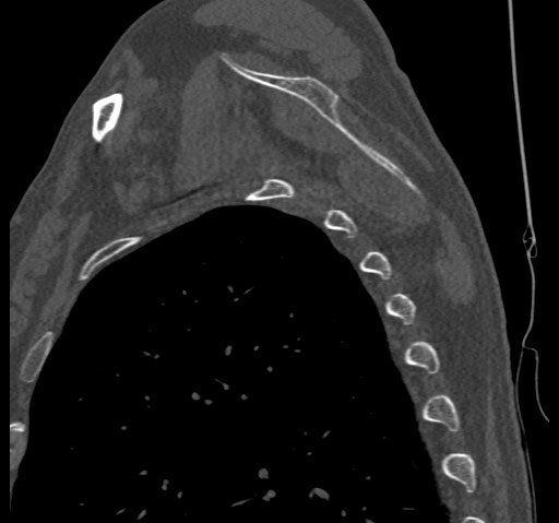 File:Anterior glenohumeral dislocation with Hill-Sachs lesion (Radiopaedia 62877-71249 Sagittal bone window 55).jpg