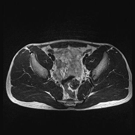 File:Anterior inferior iliac spine avulsion fracture (Radiopaedia 81312-95000 Axial T2 27).jpg