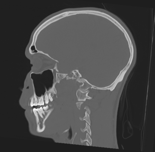 Anterior nasal spine fracture (Radiopaedia 46138-50494 Sagittal bone window 36).png