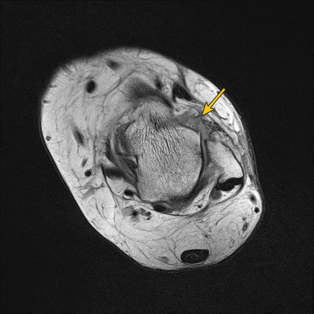 File:Anterior talofibular ligament injury - rupture with soft-tissue impingement (Radiopaedia 38765-66337 Annotated 5).jpg